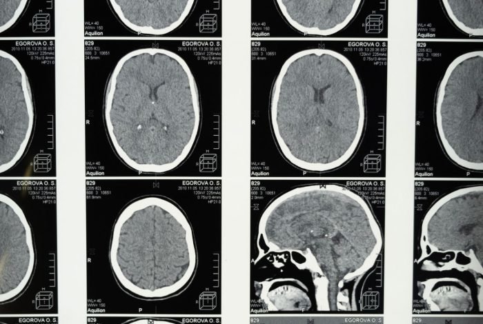 Dr Mohamed Elgaidi svc tumor